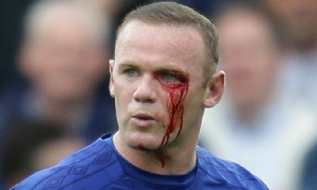 Rooney slått til blods da King scoret for Bournemouth